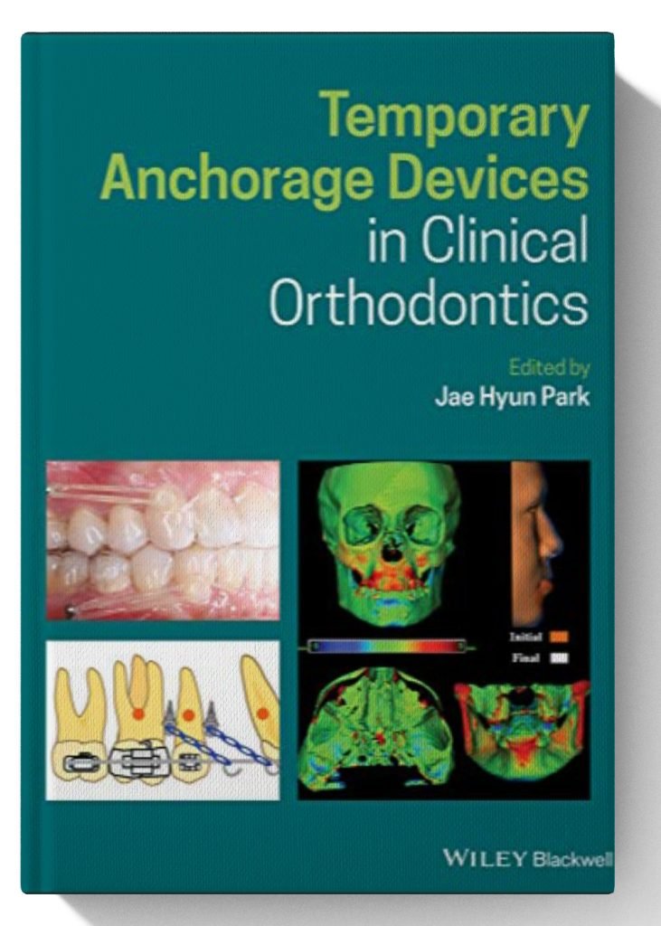 Temporary Anchorage Devices in Clinical Orthodontics 1st Edition ...